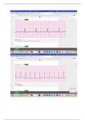 StaRN EKG Test for HCA (Lethal and Non-Lethal Rhythms) 