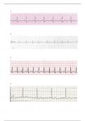 ECG rhythms from PowerPoints with Questions And Answers Graded A+