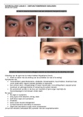 Hoorcollege casus 5 - disfunctionerende oogleden 